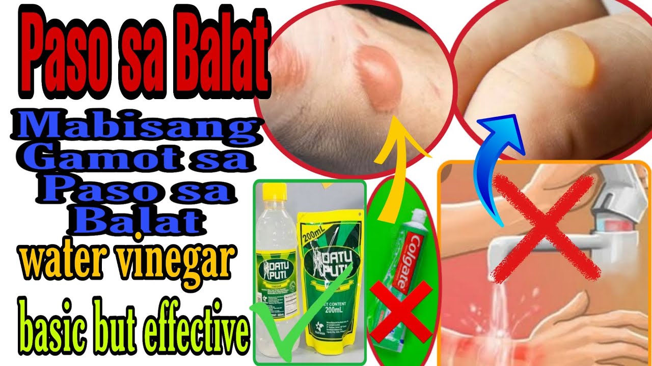 Gamot sa Paso sa balat