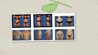 preview picture of video 'Laser Liposuction Philadelphia'
