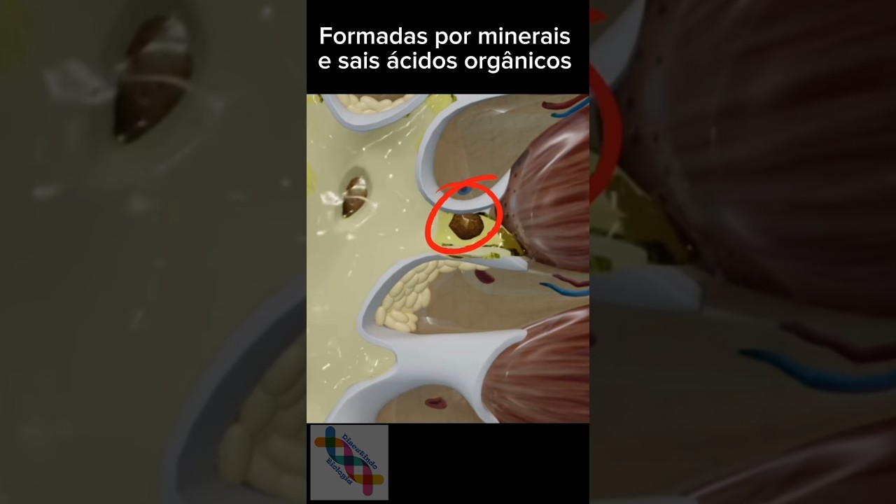 Como se forma a pedra nos rins. #short #shorts #shortshorts #shortpants #curiosidades #biologia #bio