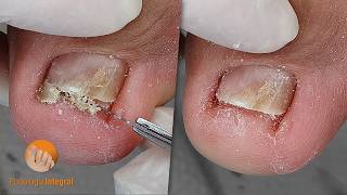 Comfort and smoothness returns when walking. Cleaning toenails & all the accumulated skin | Podology