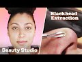 Blackhead Extraction Facial | Beauty Studio