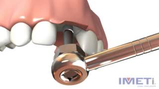 Implantes Dentales IMETI - Proceso Quirúrgico en la colocación de un implante. - Únete Odontología (lopman Plus)