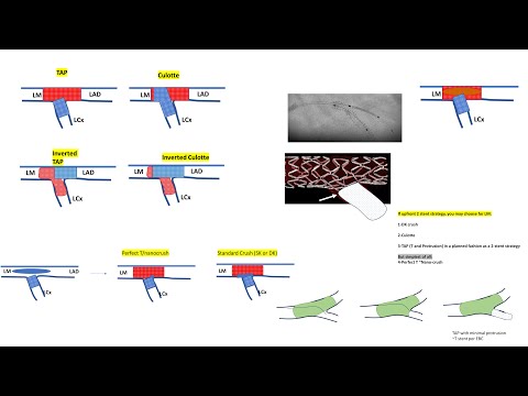 Bifurcation left main stenting- Elias Hanna