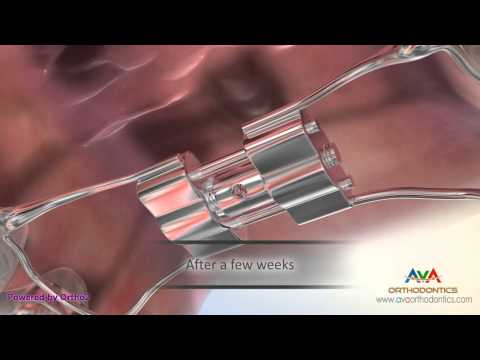 Orthodontic Expander or Spacer - Hyrax Appliance