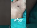 Gynecomastia Surgery Shortvideo Dezireclinicindia