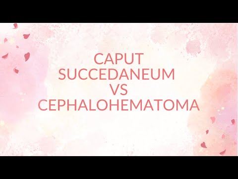 Caput Succedaneum vs Cephalohematoma