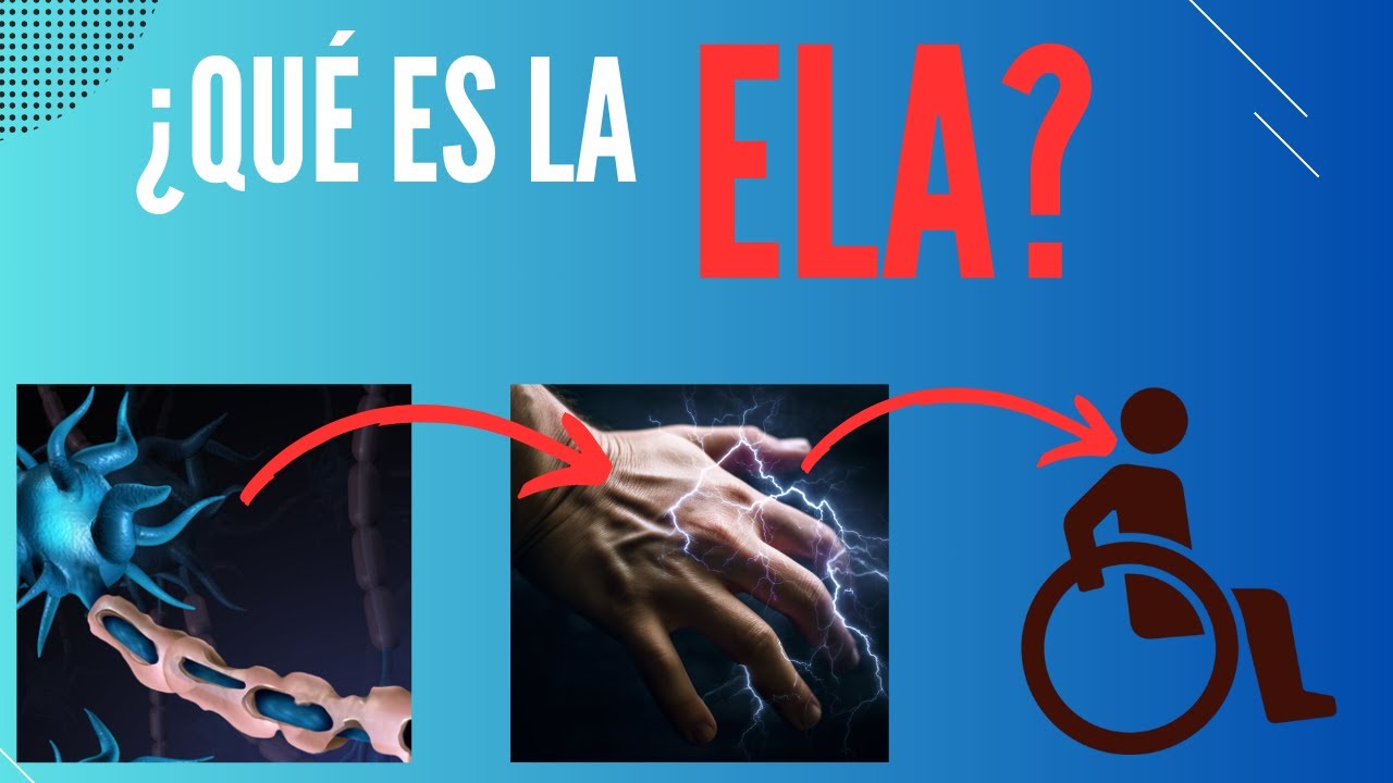 ¿Qué es la Esclerosis lateral amiotrófica?