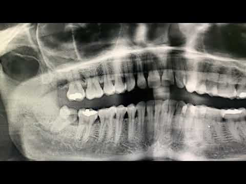 Wisdom Tooth Extraction