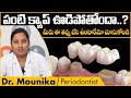 పంటి క్యాప్ ఊడిపోతే Top Reasons Why Dental Crowns Fall Off In Telu