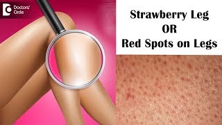 Strawberry leg | Red Bumps and Spots on Legs - Dr. Rashmi Ravindra |Doctors