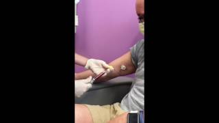 first access chemo arm port