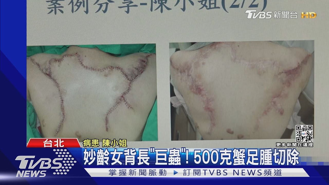 妙齡女背長「巨蟲」！　500克蟹足腫切除