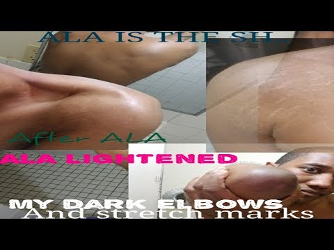 Paano alisin tiyan skin pagkatapos ng panganganak Wastong Nutrisyon binti pagbaba ng timbang at tiyan