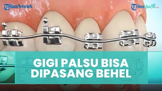 Pasien yang Pasang Gigi Palsu Bisa Dipasang Behel, Ini Penjelasan Dokter