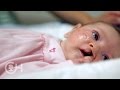 What Is Cleft Lip And Palate Causes Types And Treatment For Babies