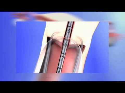 Frauenarztpraxis am Potsdamer Platz Berlin - Einlage mit Betäubung der Hormonspirale Jaydess