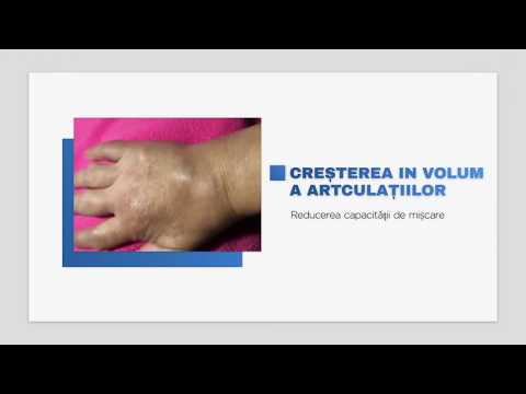 Tratament articular de afine