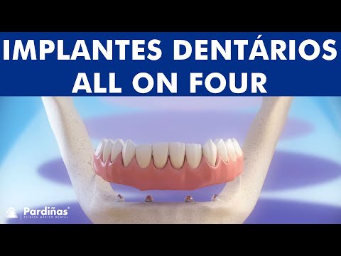 Implantes dentários All-on-4 ©