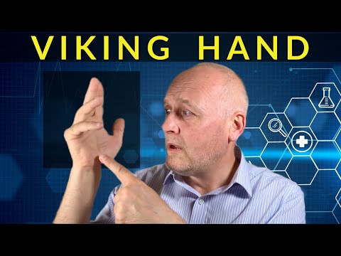 Dupuytren’s Contracture : All about the ‘Viking Hand’
