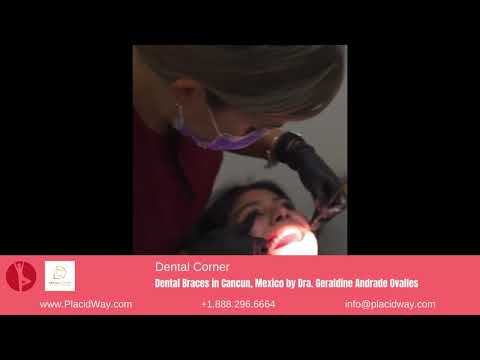 Bracing for a Radiant Smile: Dental Braces in Cancun, Mexico by Dental Corner