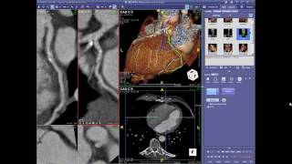 preview picture of video 'Cardiac CT Angiography Case Review Webinar 10-19-11'