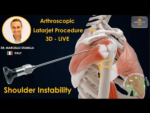 LUSSAZIONE DI SPALLA – STABILIZZAZIONE CHIRURGICA LATARJET ARTROSCOPICA 3D & LIVE BY DR. STAMILLA