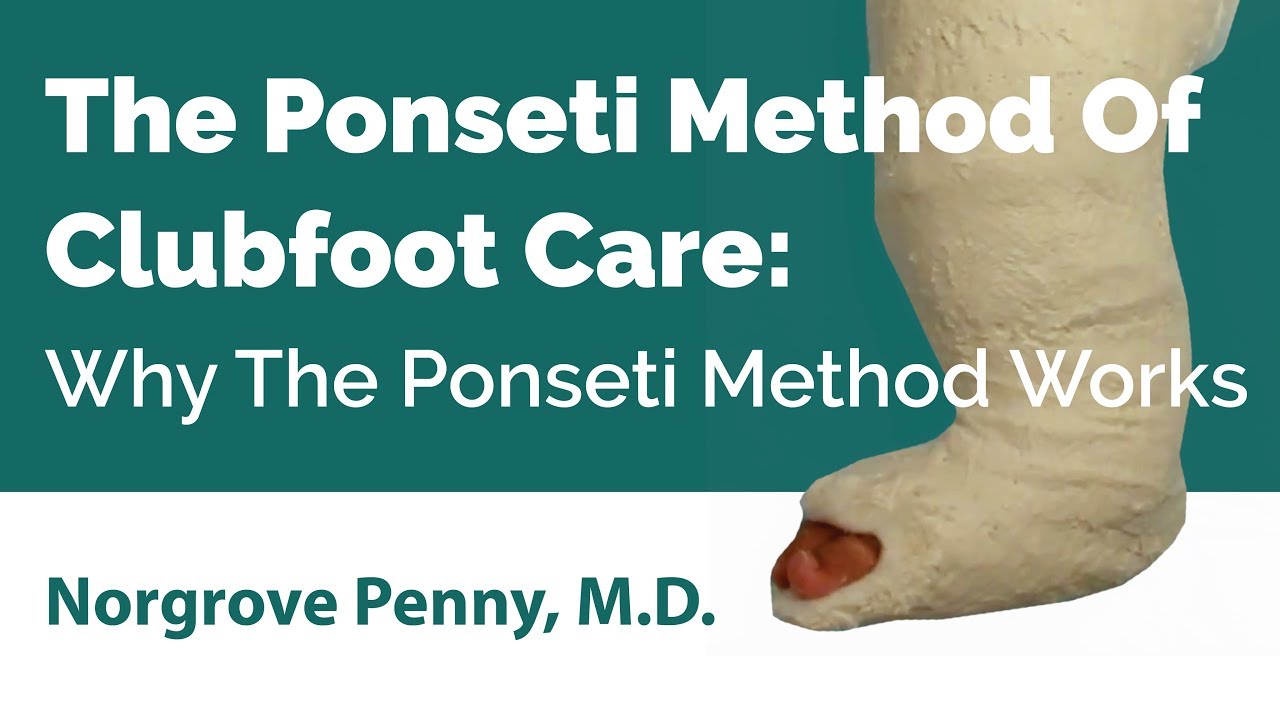 The Ponseti Method Of Clubfoot Care: Why The Ponseti Method Works