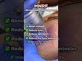 Microneedling radiofrequency | Microneedling combined with radiofrequency | Mnrf | Scar treatment