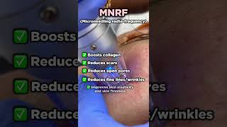 Microneedling radiofrequency | Microneedling combined with radiofrequency | Mnrf | Scar treatment