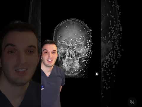 Shotgun to the 🧠 #xray #medicine #medschool #radiologist #radiology #medstudent