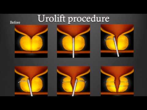 Kutusow Prostatabiopsie Screening für die Diagnose von Prostatakrebs