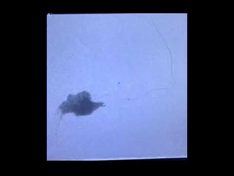 Dural AVF with cortical venous reflux