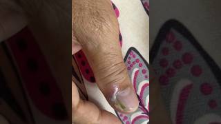 Ep_8792 Fingernails skin removal 👣 กลางคืนปวดมาก..นอนไม่ได้เลยครับ 😅 (clip from Thailand)