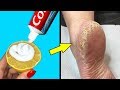 Remove Cracked Heels and Get Beautiful Feet - Magical Cracked Heels Home Remedy | Healthcare Plus