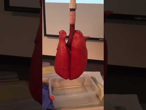 Unlocking the power of PEEP in ARDS! 🫁✨