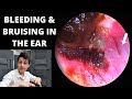 Bleeding And Bruising In the Ear Canal (Haemoglobin Breakdown Explained)