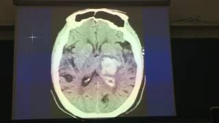 CT SỌ NÃO- BAI 2 XH  NHOI MAU  CASE LS