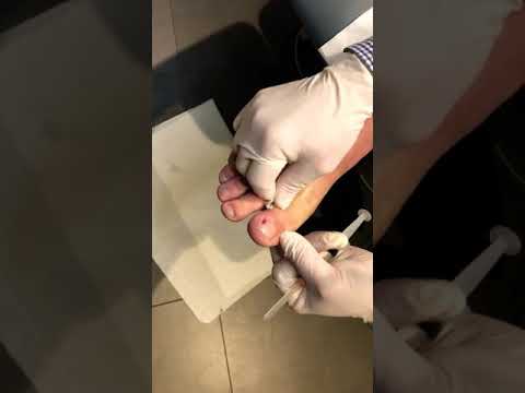 Local Anaesthetic for Ingrown Toenails - Digital Block