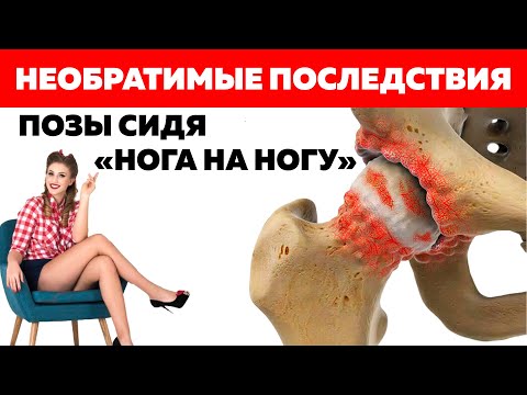 Вред для всего опорно-двигательного аппарата. Последствия сидения в позе "нога на ногу"