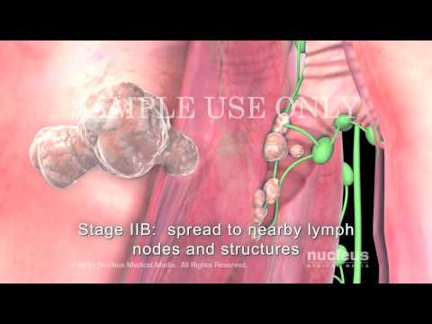 Lung Cancer Staging Non-Small Cell