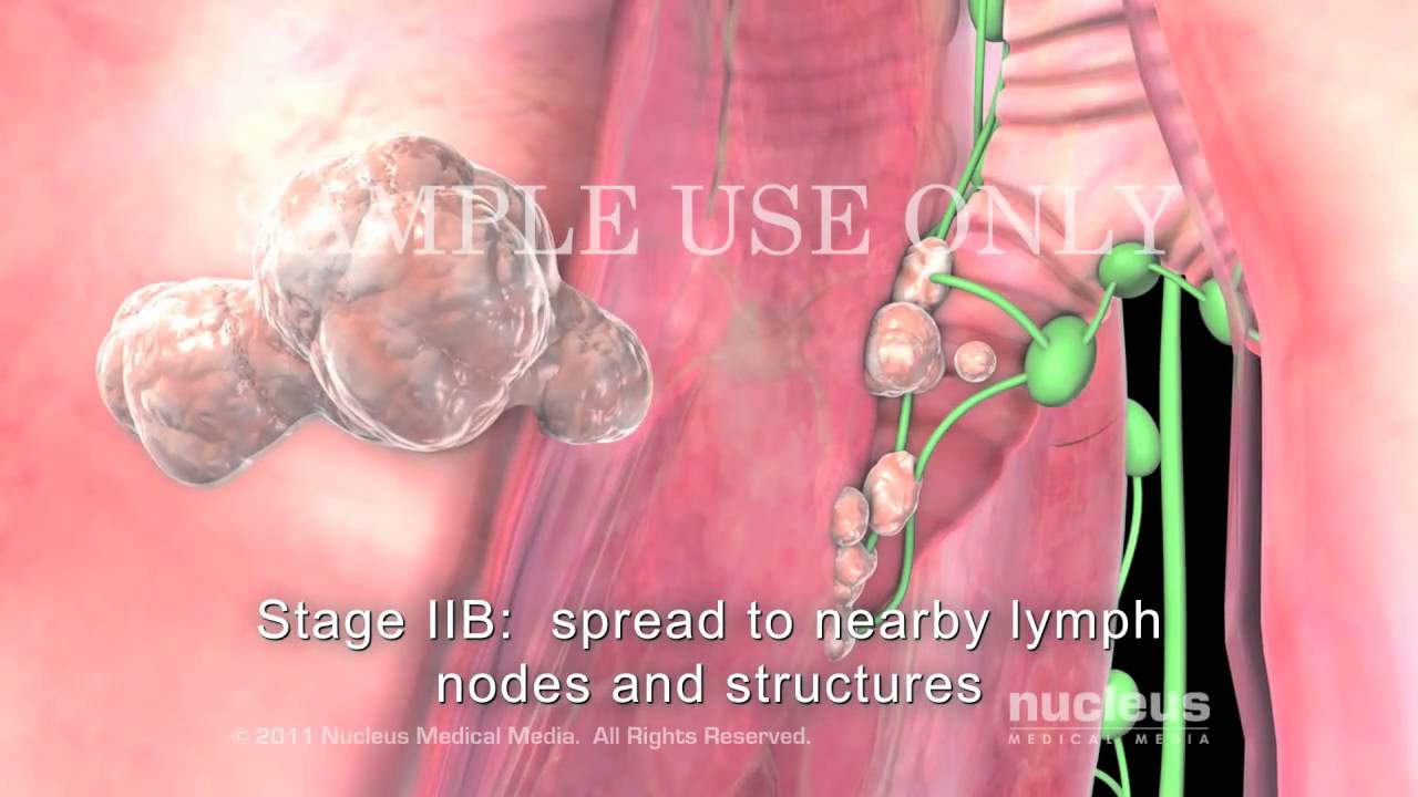 Lung Cancer Staging Non-Small Cell
