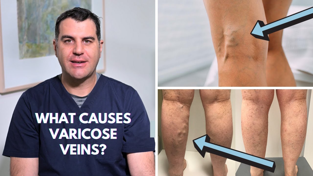 What does varicose veins mean? Tipseri