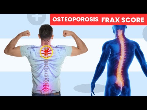 How to Detect Osteoporosis #osteoporosis
