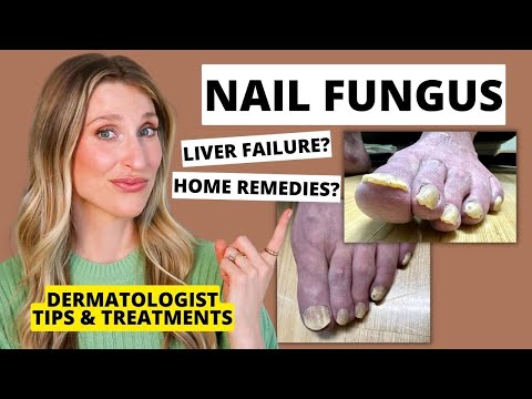 Dermatologist Shares Treatments for Nail Fungus & Prevention Tips | Dr. Sam Ellis