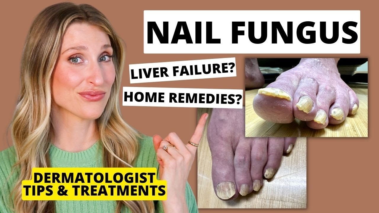 Dermatologist Shares Treatments for Nail Fungus & Prevention Tips | Dr. Sam Ellis