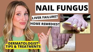 Dermatologist Shares Treatments for Nail Fungus & Prevention Tips | Dr. Sam Ellis