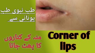 Angular stomatitis | corner of lips crack| Mun ke kinaro ka phat Jana | #viral
