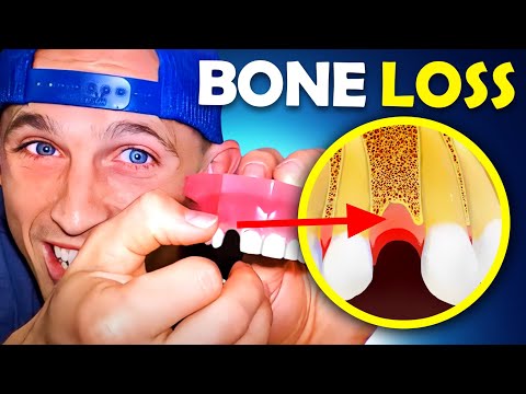 GETTING BRACES with BONE LOSS and PERIDONTAL DISEASE [watch before getting braces]