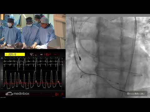 TAVI Using A 23 mm Myval Valve