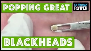 Plenty of Great Blackheads!